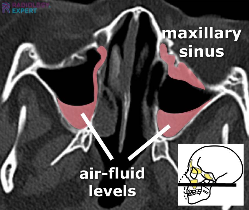 CT sinus